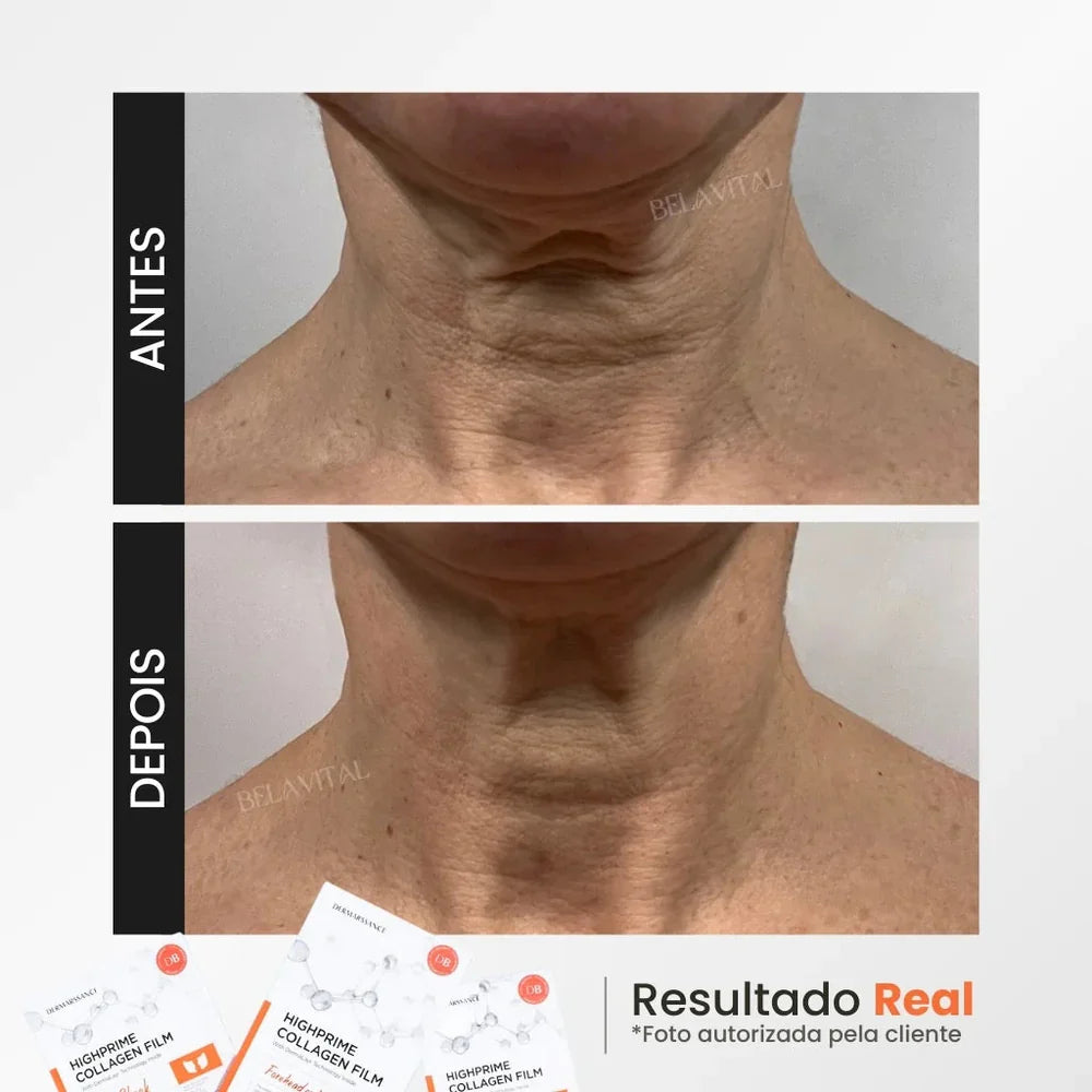 KIT GOLDBOTOX™ HIGHPRIME - COLÁGENO + ACIDO HIALURÓNICO + ACTIVO DE BOTOX