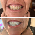 BLANQUEADOR DE DIENTES CON CARBÓN ACTIVO Y EXTRACTOS DE PLANTAS - WHITETH™